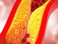Warning Sign Of Bad Cholesterol - Hindi News | Warning Sign Of Bad Cholesterol | Latest health Photos at Lokmattimes.com