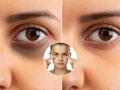 Dark Circles Solution at Home : चेहरा गोरा पण डार्क सर्कल्समुळे त्वचा काळपट वाटते? ४ सोपे उपाय, चेहरा कायम दिसेल ग्लोईंग - Marathi News | Dark Circles Solution at Home :  All About Dark Circles And How To Remove Them Permanently | Latest sakhi News at Lokmat.com