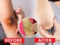 Dark Elbow Remedies : हात गोरा, कोपर काळपट दिसतात? फक्त १० रूपयात चमकदार दिसेल काळ पडलेलं कोपर - Marathi News | Dark Elbow Remedies : How to lighten dark elbows naturally | Latest sakhi News at Lokmat.com