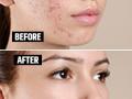 How To Remove Pimples Spots : पिंपल्समुळे चेहऱ्यावर काळे डाग, खड्डे पडलेत? ३ उपाय, चेहरा दिसेल ग्लोईंग डागविरहीत - Marathi News | How To Remove Pimples Spots : Due to pimples, black spots, pits on the face? 3 solutions, the face will look glowing | Latest sakhi Photos at Lokmat.com