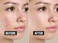 How To Remove Pimples Spots : पिंपल्समुळे चेहऱ्यावर काळे डाग, खड्डे पडलेत? ३ उपाय, चेहरा दिसेल ग्लोईंग डागविरहीत - Marathi News | How To Remove Pimples Spots : Due to pimples, black spots, pits on the face? 3 solutions, the face will look glowing | Latest sakhi Photos at Lokmat.com
