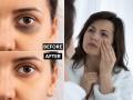 Mudra for Dark Circles : चेहरा चांगलाय पण डार्क सर्कल्सनी लूक बिघडवलाय? १ उपाय, चेहरा दिसेल ग्लोईंग   - Marathi News | Mudra for dark circles : Which mudra is good for glowing skin and removing dark circles | Latest sakhi News at Lokmat.com