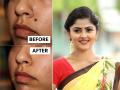 चेहऱ्यावर खूप तीळ आहेत, आवडत नाहीत? ५ उपाय, तीळ होतील कमी लवकर - Marathi News | Too many moles on the face? 5 solutions to remove moles quickly | Latest sakhi News at Lokmat.com