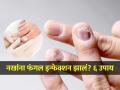 नखं फार पिवळी दिसतात, फंगल इन्फेक्शन तर नाही? नखांची अस्वच्छता महागात पडते.. - Marathi News | Nails look very yellow, fungal infection? Untidy nails are expensive. | Latest sakhi News at Lokmat.com