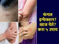 फंगल इन्फेक्शन? खाज? अंगावर चट्टे? ५ घरगुती उपाय, त्वचा विकार राहतील लांब - Marathi News | 5 Simple Home Remedies For Fungal Infections : How to Cure Fungal Infection on Skin Naturally | Latest sakhi News at Lokmat.com