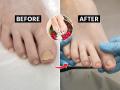 पायांच्या नखांमध्ये जमा झाली बुरशी? नखं पिवळी-काळपट पडली? २ घरगुती उपाय; नखं होतील स्वच्छ - Marathi News | How Do You Get Rid of Yellow Toenails | Latest sakhi News at Lokmat.com