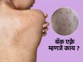 पाठीवर मुरुम ? अनेक उपाय करूनही कमी होत नाहीत, पाहा कारण आणि असरदार खास उपाय... - Marathi News | dermatologists tips on getting rid of back acne How to get rid of acne on the back How to get rid of back acne fast, according to skin experts | Latest sakhi News at Lokmat.com