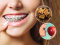 दाताला ब्रेसेस लावल्या? ४ गोष्टी खाणं टाळा; दात किडतील - दुखणं वाढेल - Marathi News | Foods You Can and Shouldn't Eat If You Have Braces | Latest sakhi News at Lokmat.com