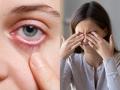 डॉक्टर सांगतात डोळ्यांची काळजी घेण्यासाठी फक्त ५ गोष्टी करा- म्हातारे झालात तरी नजर राहील तेज - Marathi News | 5 eye care tips for healthy eyes, how to take care of eyes, eye care routine for every day | Latest sakhi Photos at Lokmat.com