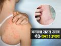 पावसाळ्यात अंगाला खूप खाज येतेय-त्वचा लाल होते? १ उपाय करा, अजिबात खाज येणार नाही - Marathi News | These 5 Home Remedies Will Help You Get Rid Of Itching And Scabies | Latest sakhi Photos at Lokmat.com