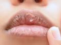 हिवाळ्यात ओठ फुटण्याच्या समस्येने त्रस्त, 'हे' घरगुती आणि आयुर्वेदिक उपाय करतील मदत - Marathi News | Suffering from the problem of chapped lips in winter, these home and Ayurvedic remedies will help | Latest sakhi News at Lokmat.com