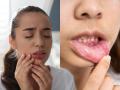 माउथ अल्सरने त्रस्त झालात?.. हे 'सहा' घरगुती उपाय करून बघा - Marathi News | Suffering from mouth ulcers?.. Try these 'six' home remedies | Latest sakhi News at Lokmat.com