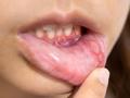 माउथ अल्सरने त्रस्त झालात?.. हे 'सहा' घरगुती उपाय करून बघा - Marathi News | Suffering from mouth ulcers?.. Try these 'six' home remedies | Latest sakhi News at Lokmat.com
