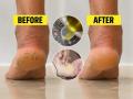 तळपायाच्या भेगा कमी होतच नाहीत? 'हा' घरगुती उपाय करा- २ दिवसांत पाय होतील मऊ- मुलायम  - Marathi News | best home remedies for cracked heel, how to make cracked heels soft, best cream for cracked heels | Latest sakhi News at Lokmat.com