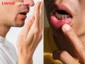 तुमच्या तोंडातून दुर्गंधी येते का? दातांची ही समस्या असेल प्रमुख कारण - Marathi News | Does your mouth smell bad? This dental problem could be the main reason | Latest gondia News at Lokmat.com