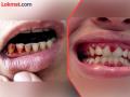 दात गळतात, हिरड्यांतून रक्तस्राव; 'स्कर्वी' आजार कशामुळे होतो ? - Marathi News | Teeth fall out, gums bleed; What causes 'scurvy' disease? | Latest gondia News at Lokmat.com