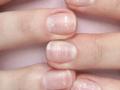 तुमच्याही नखांवर पांढरे डाग आहेत का? हे डाग म्हणजे आजार की गंभीर आजाराची लक्षणं - Marathi News | Do you have white spots on your nails? These spots are a sign of illness, read to learn more | Latest sakhi News at Lokmat.com