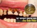 १ ग्लास पाण्यात 'हा' पदार्थ घालून गुळण्या करा; दातांची कीड सुसाट बाहेर निघेल-डॉक्टरांचा सल्ला - Marathi News | Ayurveda Dr Saleem Zaidi Share Triphala Mouthwash Recipe To Get Rid Of Cavity | Latest sakhi News at Lokmat.com