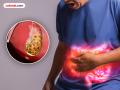 सतत ॲसिडिटी, पोटही दुखतेय; पित्ताशयात खडे तर झाले नाहीत? - Marathi News | Constant acidity, stomach ache; are there gallstones? | Latest maharashtra Photos at Lokmat.com