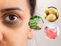 डार्क सर्कल्स खूपच दिसतात? ५ पारंपरिक उपाय-घरातले बटाटे-टोमॅटो घालवतील काळी वर्तुळं.. - Marathi News | How To Get Rid Of Dark Circles : You Tuber Patil Aaji Suggest Home Remedies For Dark Circles | Latest sakhi News at Lokmat.com