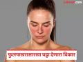 हा ब्लश नाही, महिलांना होणारा गंभीर आजार आहे; लुपस विकार ज्याने गर्भपातही होऊ शकतो - Marathi News | This is not a blush, it is a serious disease that affects women; Lupus disorder which can also cause miscarriage | Latest health Photos at Lokmat.com