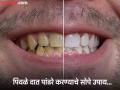 दातांचा पिवळेपणा घालवणारे ४ आयुर्वेदिक उपाय, एकदा करून बघाच... - Marathi News | Teeth whitening tips 4 home made ayurvedic manjan | Latest beauty News at Lokmat.com