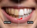 Teeth Whitening At Home : दातांवर पिवळा थर - हिरड्या काळ्या? १ सोपा उपाय- पिवळे पडलेले दात चमकतील मोत्यांसारखे... - Marathi News | How to whiten yellow teeth naturally at home yellow teeth remedy black gums treatment | Latest sakhi Photos at Lokmat.com