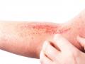 Skin allergies : पावसाळ्यात त्वचेवरची एलर्जी अन् रॅशेजपासून अशी मिळवा सुटका; खाज, पुरळ नेहमी राहील दूर - Marathi News | Skin allergies: Tips to treat monsoon skin allergies and rashes | Latest sakhi News at Lokmat.com