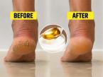 हिवाळ्यात फुटलेल्या टाचांसाठी ६ घरगुती उपाय! भेगाळलेल्या टाचाही होतील मुलायम, सुंदर - वेदना, दुखणे होईल कमी... - Marathi News | 6 home remedies for cracked heels in winter home remedies for dry and cracked heels cracked heels home remedies | Latest sakhi Photos at Lokmat.com