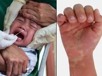 Coronavirus: कोरोना संबधित रहस्यमय रोगाचा लहान मुलांना धोका; अमेरिकेसह अनेक देश चिंतेत! - Marathi News | children getting severely symptoms similar to Kawasaki disease and toxic shock-like syndrome pnm | Latest international Photos at Lokmat.com