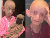 ना दात, ना डोक्यावर केस, १८ वर्षाची ही मुलगी झाली होती १४४ वर्षाची! - Marathi News | A girl was suffering from progeria disease and looked 144 years, when she was eighteen | Latest jarahatke Photos at Lokmat.com