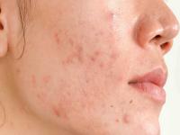 पिंपल्स आणि डागांपासून होईल सुटका; फक्त करा 'हे' घरगुती उपाय - Marathi News | Beauty Tips Home remedies for pimples and acne | Latest beauty Photos at Lokmat.com