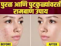 चेहऱ्यावरील बारीक पुरळ घालवण्यासाठी घरगुती उपाय | How To Get Rid of Tiny Bumps on Face |