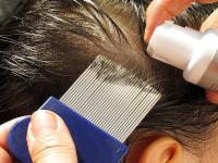 आनंदाची बातमी : 'उवा' मारण्यासाठी वापरल्या जाणाऱ्या 'या' औषधाने काही तासांतच केला कोरोनाचा 'खात्मा'!; क्लिनिकल ट्रायल सुरू - Marathi News | CoronaVirus Marathi News head lice drug ivermectin clinical trials started against corona virus sna | Latest international Photos at Lokmat.com