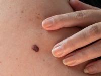 चेहरा-पाठीवरची चामखीळ कमी होणारा सोपा उपाय-नारळाच्या तेलात ५ गोष्टी मिसळून लावा - Marathi News | how to reduce back acne naturally chamkhil 5 Ingredients in Coconut Oil and Apply face and body acne home remedy | Latest sakhi Photos at Lokmat.com