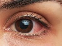 डोळे सांगतात कोलेस्टेरॉल वाढण्याची ५ लक्षणे! नियमित खा ' हे ' पदार्थ, हॉर्ट ॲटॅकचा धोका टाळा.. - Marathi News | signs of high cholesterol in eyes early signs of cholesterol increase foods to reduce prevent heart attack with diet | Latest sakhi Photos at Lokmat.com