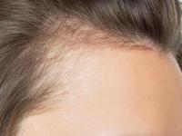 झटपट केस गळती थांबवणारे स्वयंपाकघरातले ५ पदार्थ, केस गळणं थांबेल कसं या प्रश्नाचं उत्तर! - Marathi News | How can I stop my hair fall naturally? hair loss remedies 5 home remedies | Latest sakhi Photos at Lokmat.com