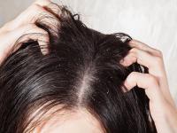 केसांमधील कोंडा दूर करण्यासाठी अगदी सोप्या घरगुती टिप्स - Marathi News | Monsoon hair care tips 5 ways to get rid of hair loss dandruff hair mash in the rain | Latest beauty Photos at Lokmat.com