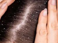 हिवाळ्यात डोक्यातला कोंडा खूपच वाढला? स्वयंपाक घरातले ४ पदार्थ लावा, काही दिवसांतच कोंडा गायब - Marathi News | how to get rid of dandruff in winter, home hacks to reduce dandruff, home remedies to get rid of dandruff | Latest sakhi Photos at Lokmat.com