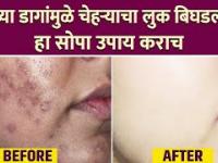 काळ्या डागांवर घरगुती उपाय| | How To get Rid Dark Spots On Face | Dark Spots Home Remedy