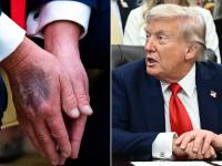 ट्रम्प यांचे हात निळे का पडले? अमेरिकन राष्ट्राध्यक्षांच्या प्रकृतीचं गूढ वाढलं; खुद्द ट्रम्प यांनीच सांगितलं कारण! - Marathi News | Why did Trump's hands turn blue? The mystery of the American President's health has increased; Trump himself explained the reason! | Latest international News at Lokmat.com