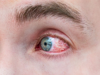 Eye Infections: मुंबईत वाढताहेत संसर्गाचे रुग्ण; डोळ्यांत डोळे घालाल तर पस्तावाल, 'अशी' घ्या काळजी! - Marathi News | Eye Infections: Infection patients are increasing in Mumbai; If you put eye drops in your eyes, you will regret it, be careful! | Latest mumbai News at Lokmat.com