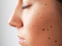 सर्जरी नाही तर 'या' घरगुती उपायांनी दूर करा चेहऱ्यावरील तीळ! - Marathi News | home remedies for facial mole removal | Latest beauty Photos at Lokmat.com