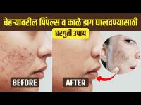 पिंपल्स आणि पिंपल्सचे डाग घालवण्यासाठी उपाय | Natural Remedies To Get Rid Of Dark Spot | Dark Spot