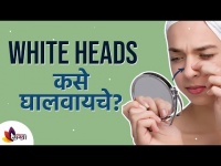 व्हाईट हेड्स कोणाला होऊ शकतात आणि त्यावरील उपाय | Home Remedy for white Heads | Lokmat Sakhi
