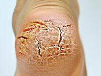 बारमाही पायांच्या टाचांना भेगा पडतात? ६ सवयी बदला - भेगा गायब टाचा सुंदर.... - Marathi News | daily habits to prevent cracked heels easy home remedies for cracked heels natural ways to cure cracked heels how to heal cracked heels naturally | Latest sakhi Photos at Lokmat.com