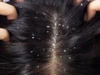 केसात कोंडा-पांढरे केस या फक्त केसांच्या समस्या नाही, तुम्हाला असू शकतात गंभीर शारीरिक त्रास - Marathi News | what do your hair tells about your health, relation between hair issues and health problems, dandruff, gray hair, hair loss is the symptom of.. | Latest sakhi Photos at Lokmat.com