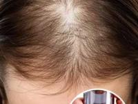 केस गळून टक्कल पडण्याची वेळ आली? रात्री केसांना लावा 'हे' पाणी, महिनाभरात नव्याने केस उगवतील - Marathi News | home hacks for thick hair, how to get thick hair, hair fall control remedies, how to control hair fall | Latest sakhi Photos at Lokmat.com