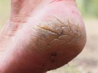 हिवाळ्यात फुटलेल्या टाचांसाठी ६ घरगुती उपाय! भेगाळलेल्या टाचाही होतील मुलायम, सुंदर - वेदना, दुखणे होईल कमी... - Marathi News | 6 home remedies for cracked heels in winter home remedies for dry and cracked heels cracked heels home remedies | Latest sakhi Photos at Lokmat.com