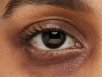 डोळ्यांभोवती डार्क सर्कल्स वाढण्यामागची ३ आयुर्वेदिक कारणं आणि सोपे उपाय- काळी वर्तुळं कमी होतील - Marathi News | 3 main ayurvedic reasons for dark circles, how to get rid of dark circles | Latest sakhi Photos at Lokmat.com